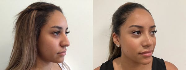 Rhinoplasty Before & After Gallery - Patient 152754 - Image 1