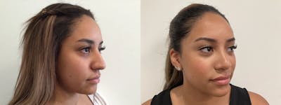 Rhinoplasty Before & After Gallery - Patient 152754 - Image 1