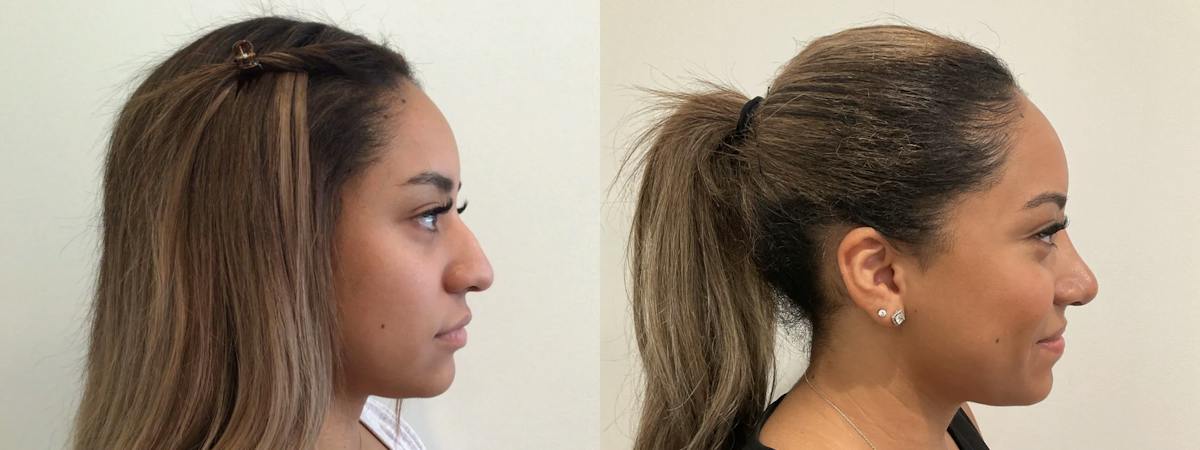 Rhinoplasty Before & After Gallery - Patient 152754 - Image 2
