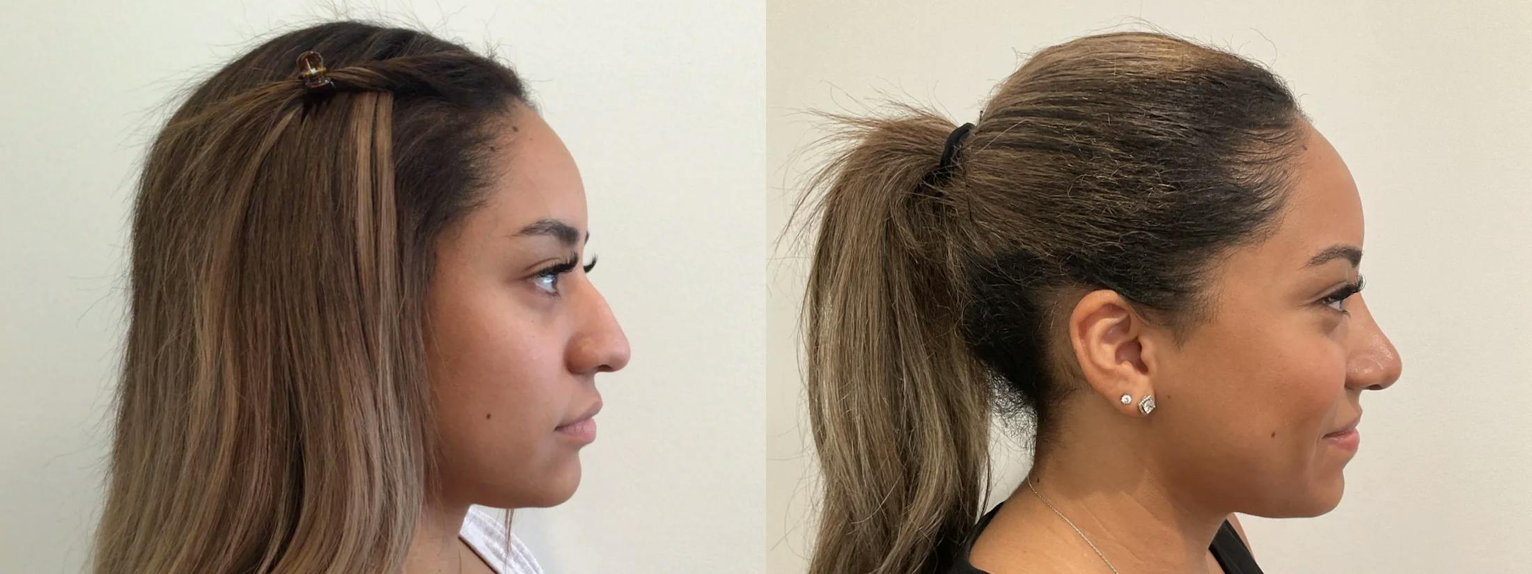 Rhinoplasty Before & After Gallery - Patient 152754 - Image 2