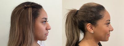 Rhinoplasty Before & After Gallery - Patient 152754 - Image 2