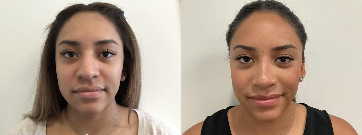 Rhinoplasty Before & After Gallery - Patient 152754 - Image 3