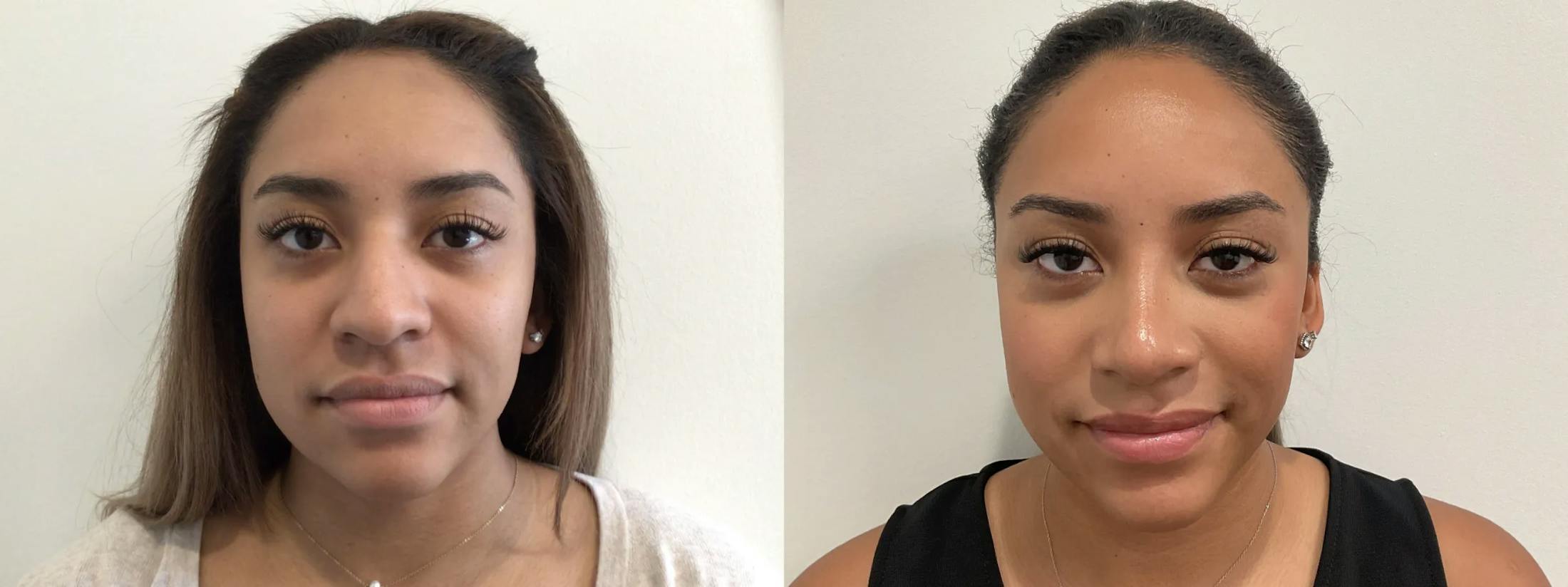 Rhinoplasty Before & After Gallery - Patient 152754 - Image 3
