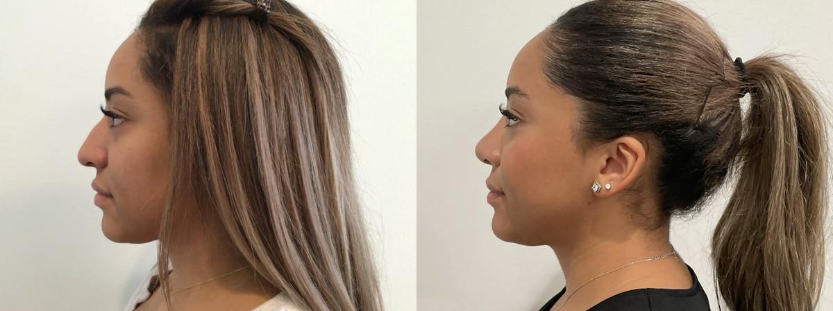 Rhinoplasty Before & After Gallery - Patient 152754 - Image 4