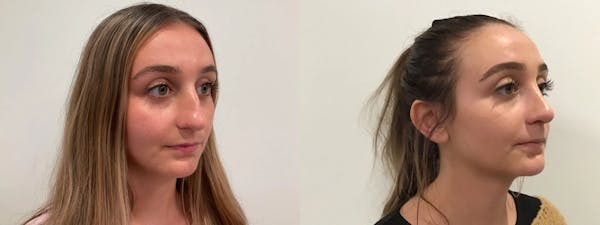 Rhinoplasty Before & After Gallery - Patient 163203 - Image 1