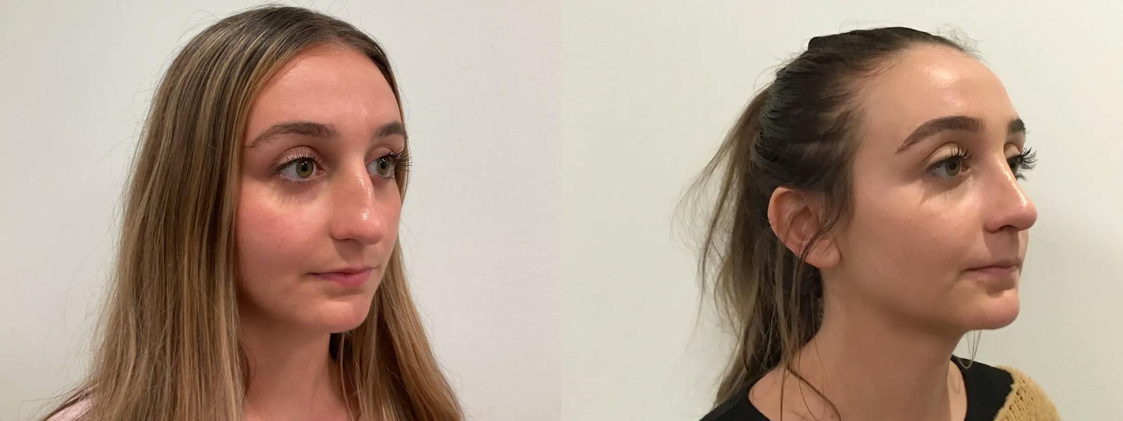 Rhinoplasty Before & After Gallery - Patient 163203 - Image 1