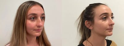 Rhinoplasty Before & After Gallery - Patient 163203 - Image 1