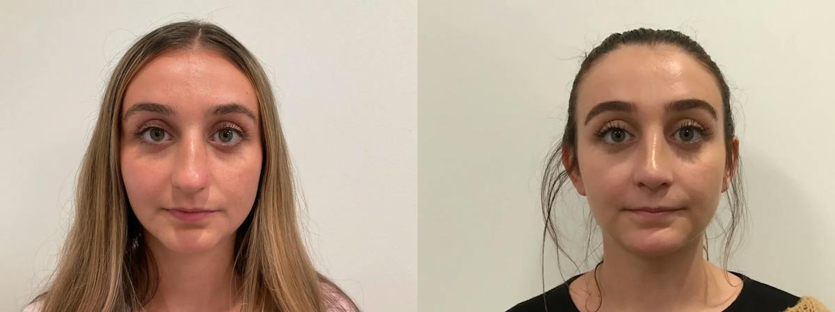 Rhinoplasty Before & After Gallery - Patient 163203 - Image 2