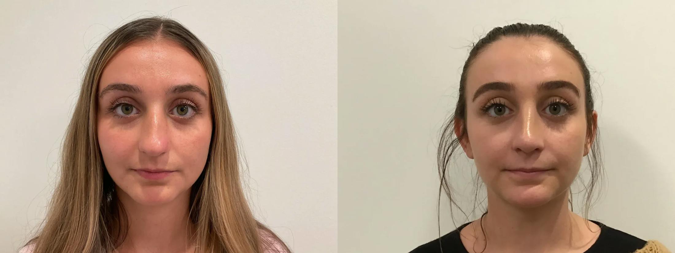 Rhinoplasty Before & After Gallery - Patient 163203 - Image 2