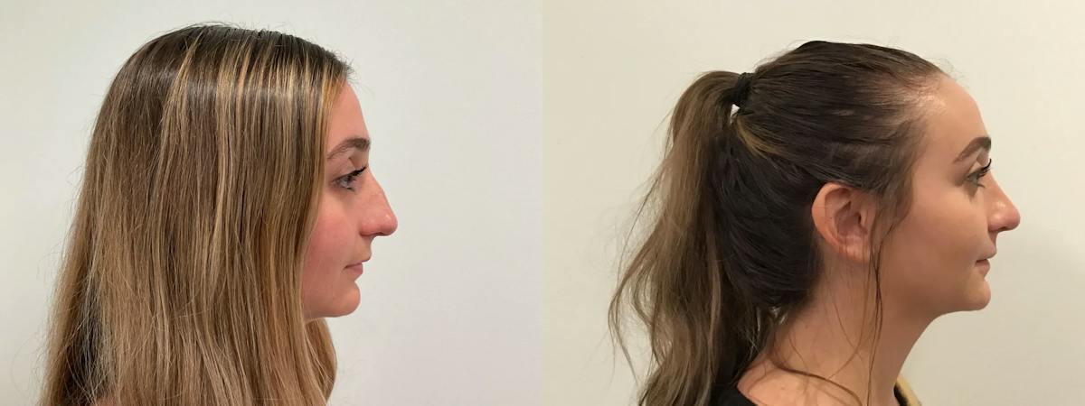 Rhinoplasty Before & After Gallery - Patient 163203 - Image 3