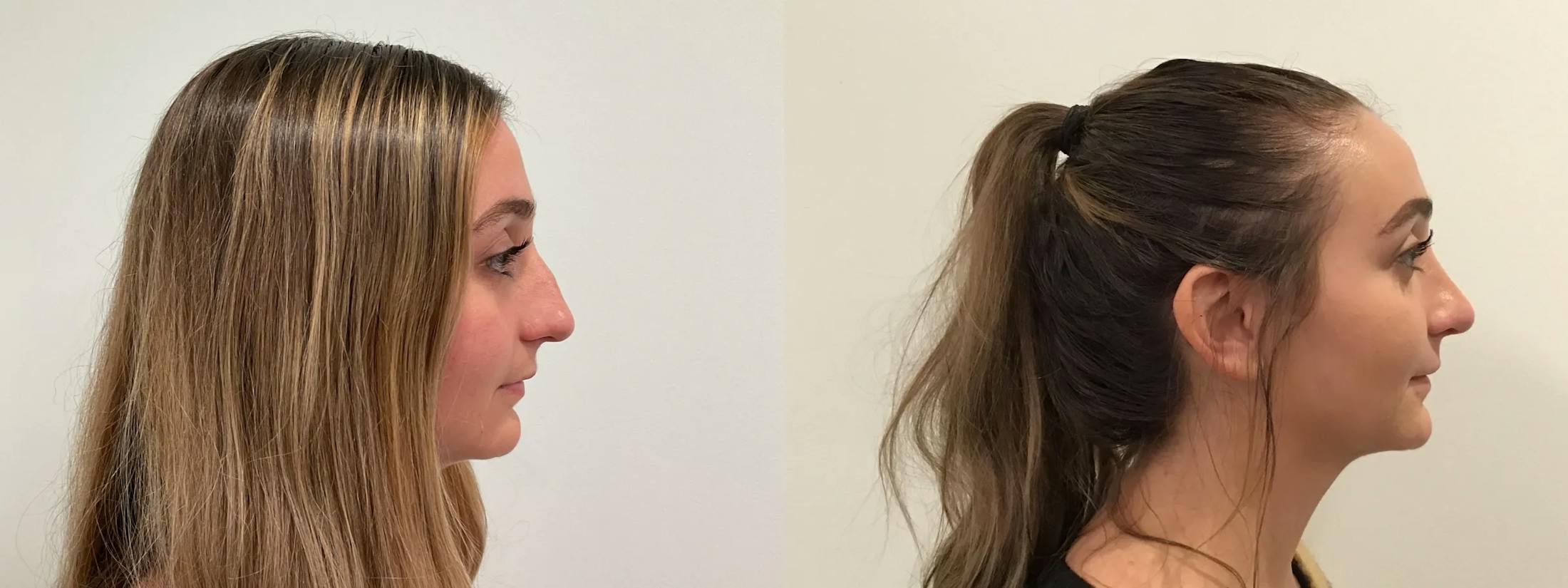 Rhinoplasty Before & After Gallery - Patient 163203 - Image 3