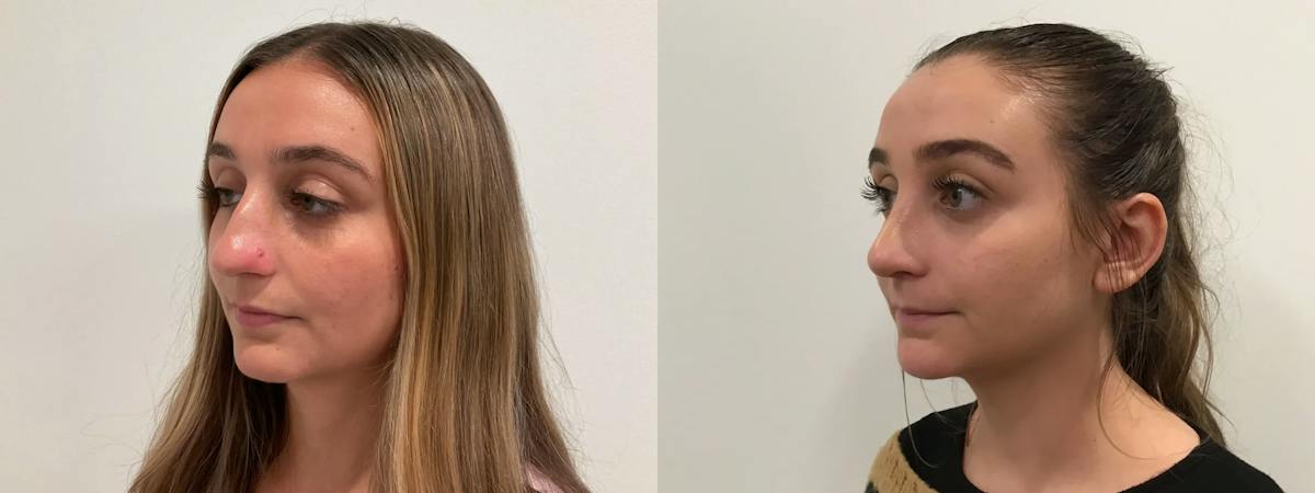 Rhinoplasty Before & After Gallery - Patient 163203 - Image 4
