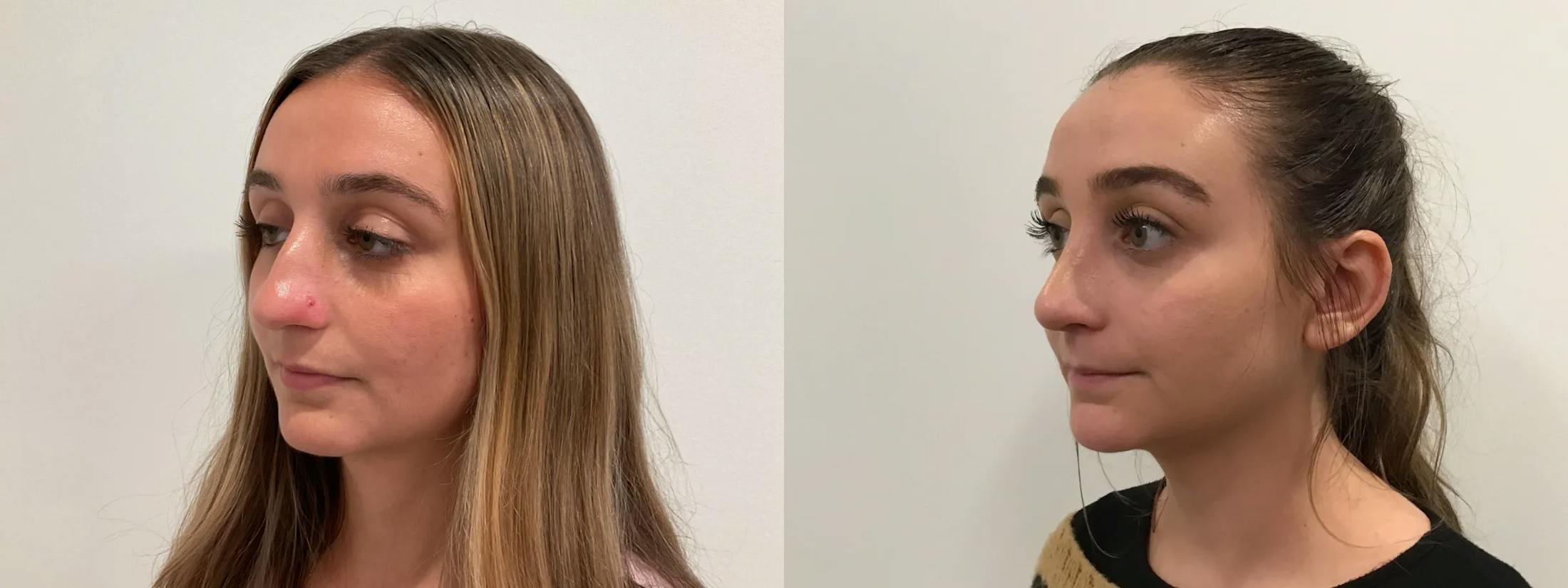 Rhinoplasty Before & After Gallery - Patient 163203 - Image 4