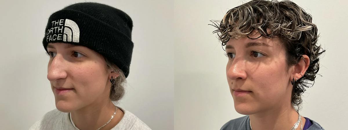 Rhinoplasty Before & After Gallery - Patient 220589 - Image 1