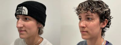 Rhinoplasty Before & After Gallery - Patient 220589 - Image 1