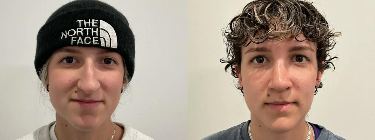 Rhinoplasty Before & After Gallery - Patient 220589 - Image 2