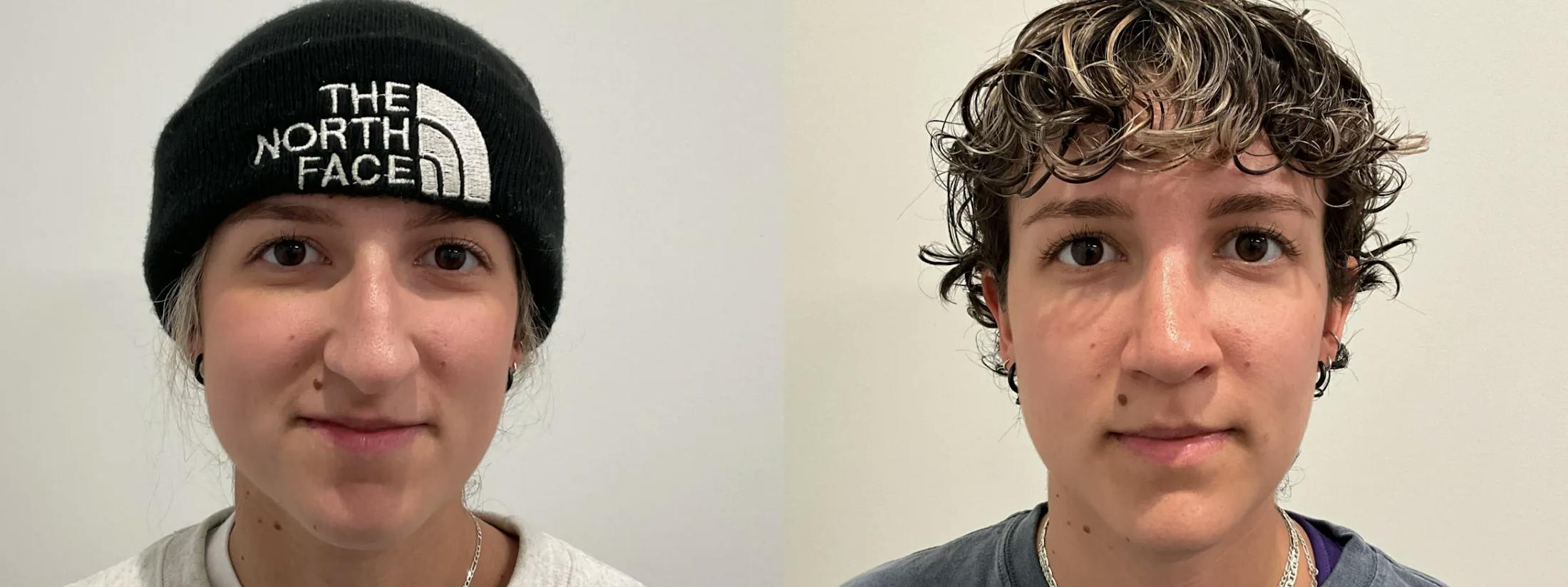 Rhinoplasty Before & After Gallery - Patient 220589 - Image 2