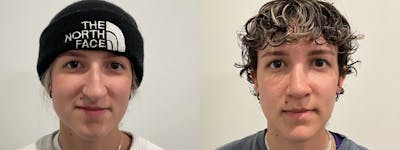 Rhinoplasty Before & After Gallery - Patient 220589 - Image 2