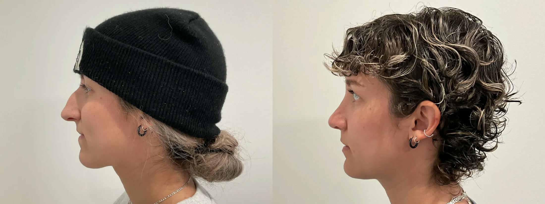 Rhinoplasty Before & After Gallery - Patient 220589 - Image 3