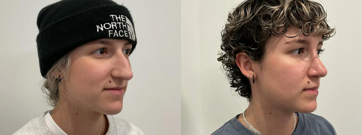 Rhinoplasty Before & After Gallery - Patient 220589 - Image 4