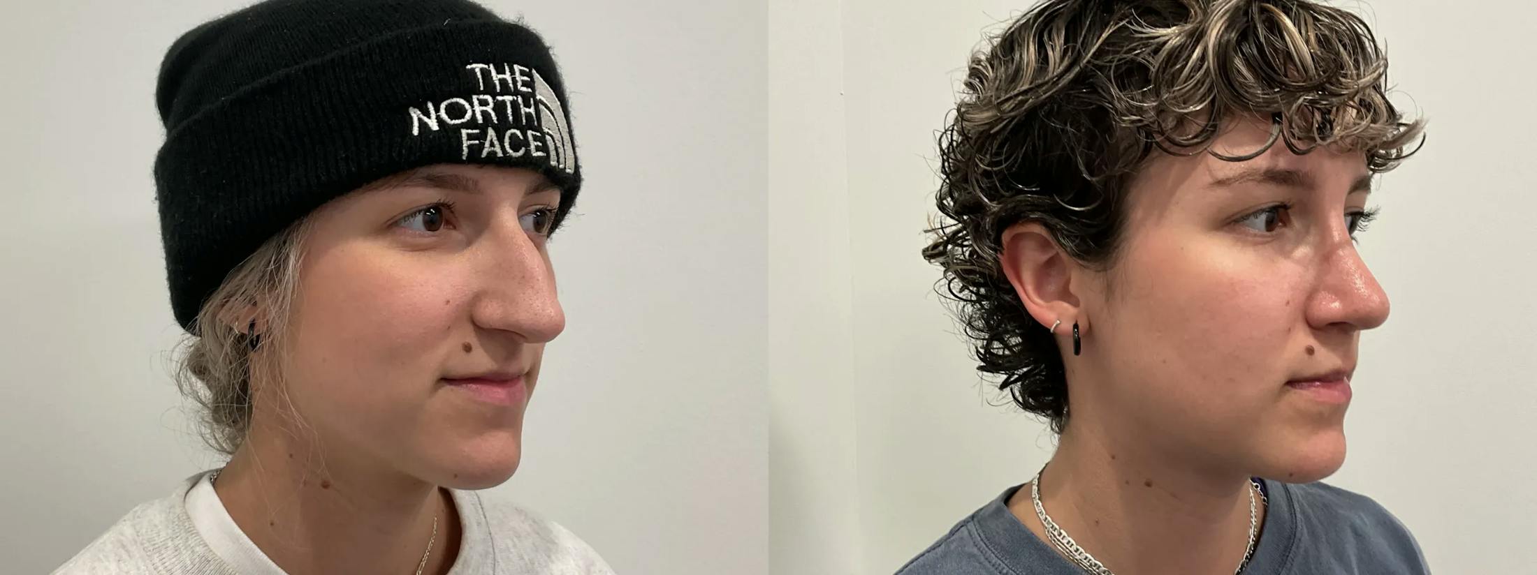 Rhinoplasty Before & After Gallery - Patient 220589 - Image 4