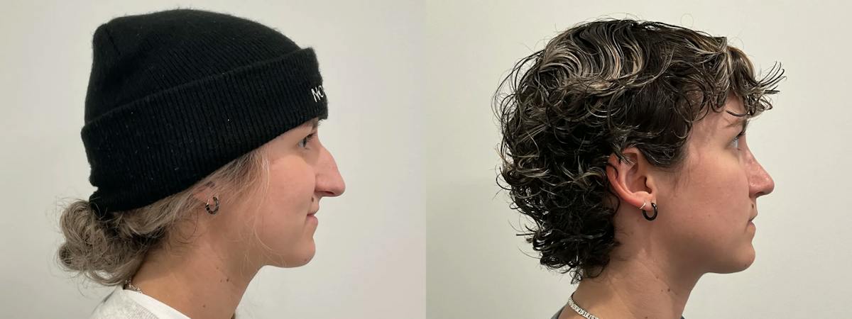 Rhinoplasty Before & After Gallery - Patient 220589 - Image 5