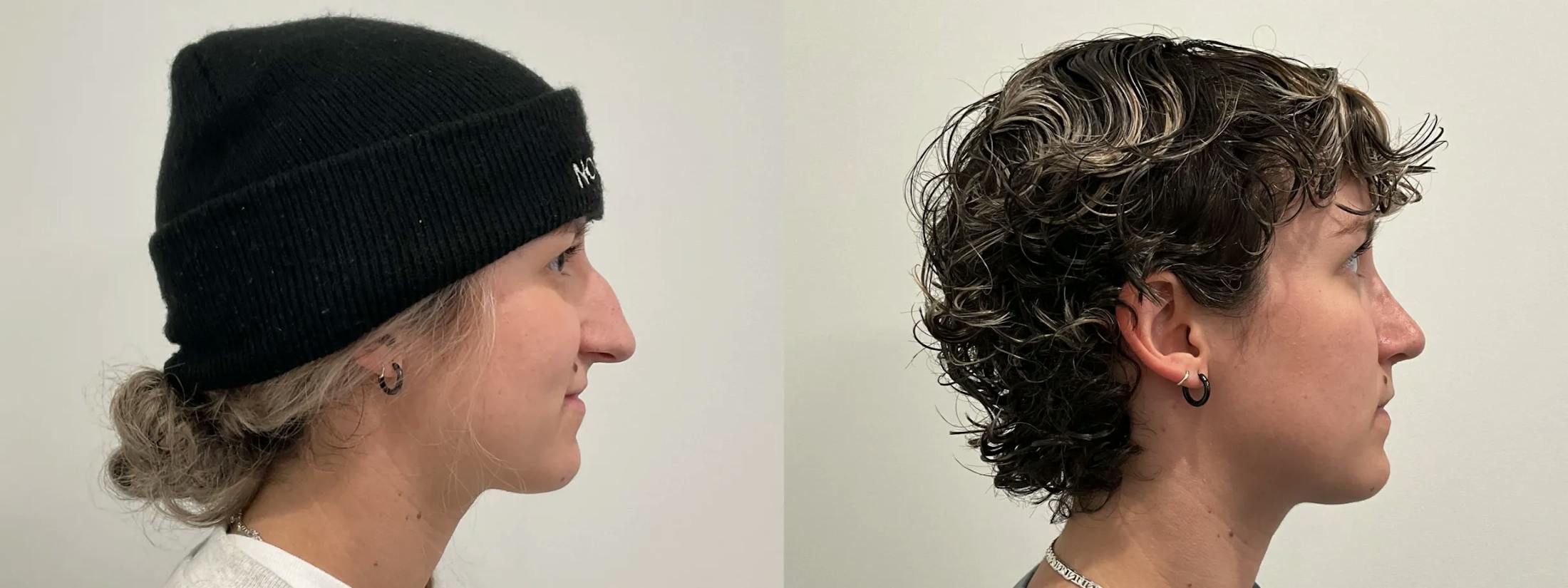 Rhinoplasty Before & After Gallery - Patient 220589 - Image 5