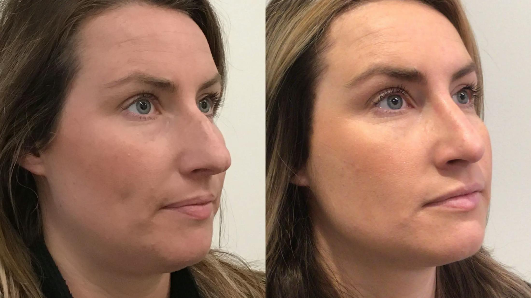 Rhinoplasty Before & After Gallery - Patient 335515 - Image 1