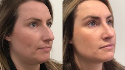 Rhinoplasty Before & After Gallery - Patient 335515 - Image 1