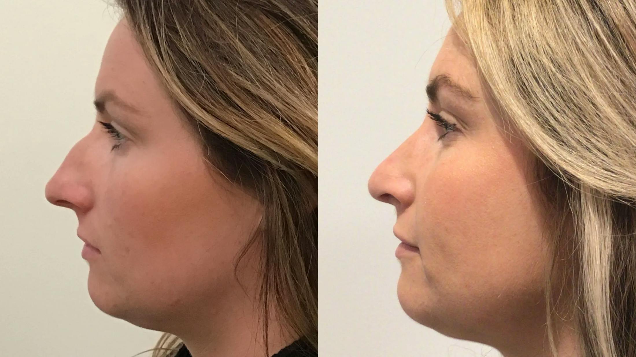 Rhinoplasty Before & After Gallery - Patient 335515 - Image 2