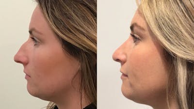 Rhinoplasty Before & After Gallery - Patient 335515 - Image 2