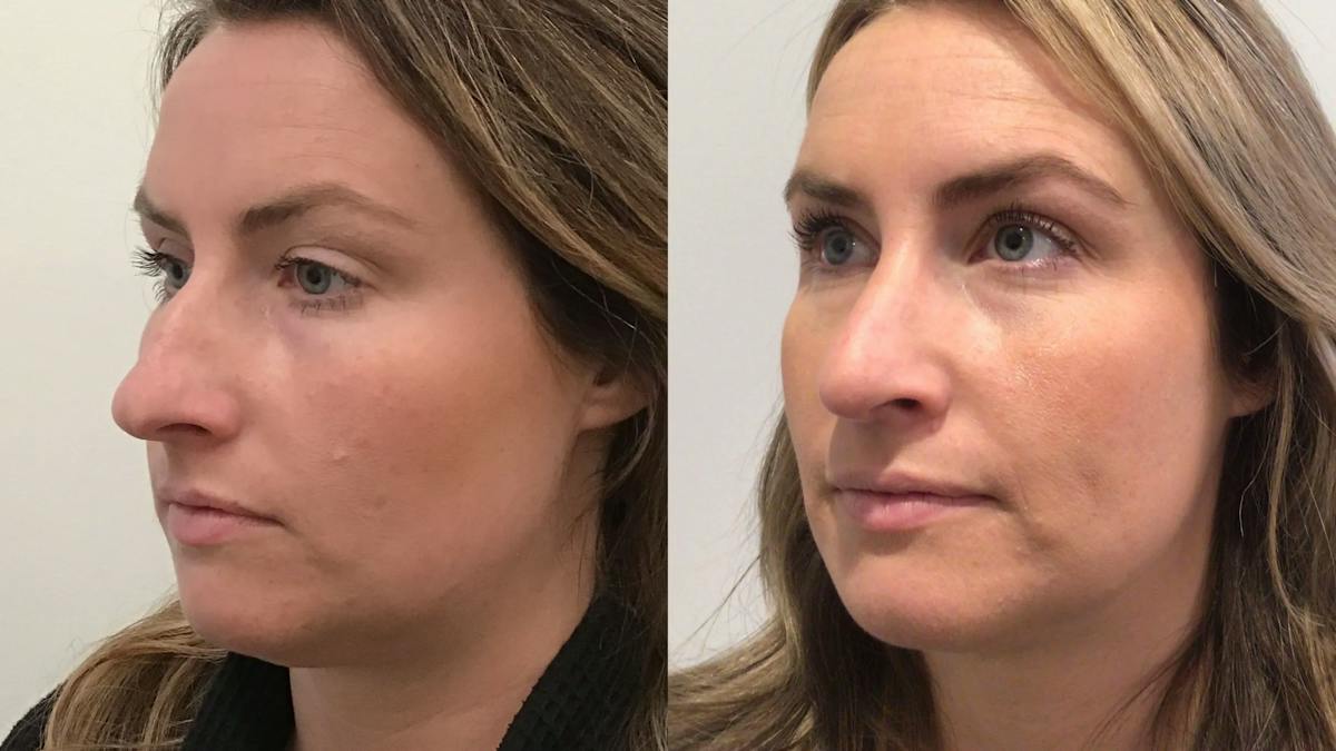 Rhinoplasty Before & After Gallery - Patient 335515 - Image 3