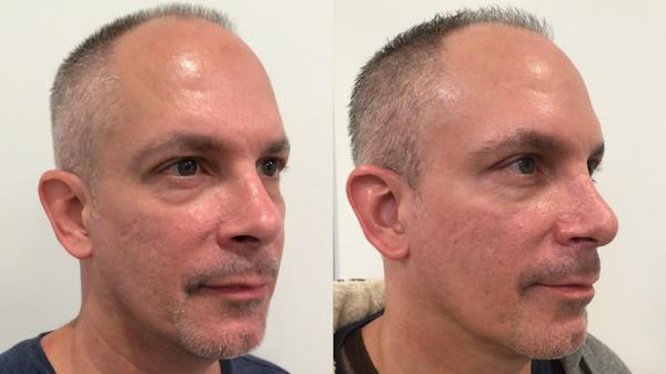 Rhinoplasty Before & After Gallery - Patient 170646 - Image 1