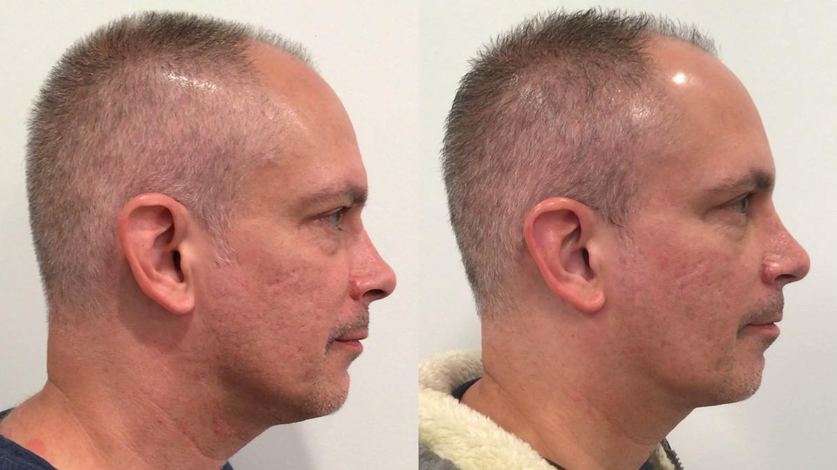 Rhinoplasty Before & After Gallery - Patient 170646 - Image 2