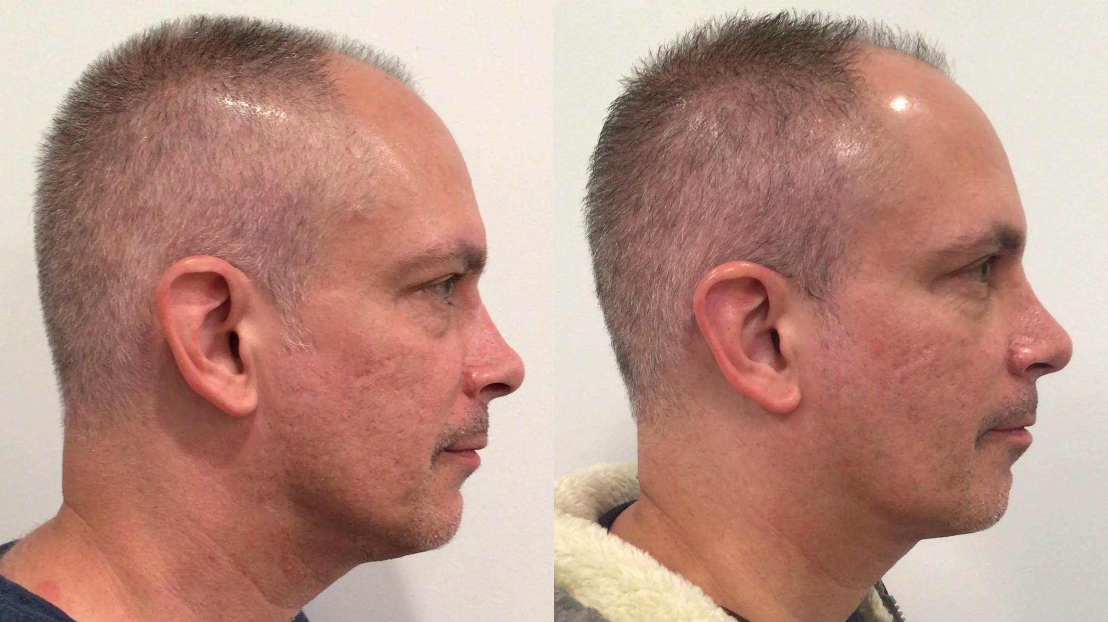 Rhinoplasty Before & After Gallery - Patient 170646 - Image 2