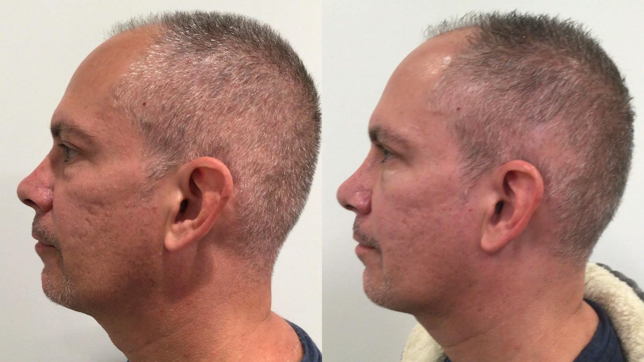 Rhinoplasty Before & After Gallery - Patient 170646 - Image 3