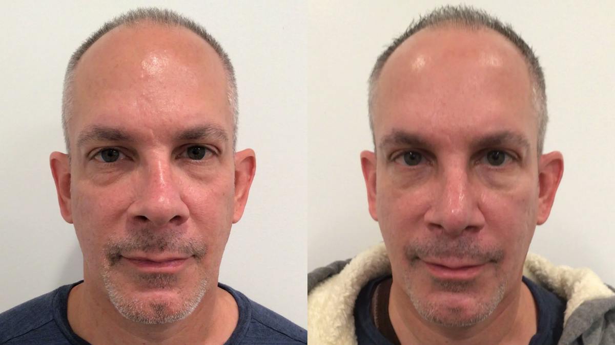 Rhinoplasty Before & After Gallery - Patient 170646 - Image 4