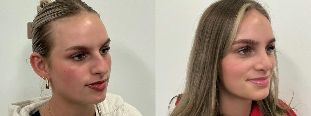Rhinoplasty Before & After Gallery - Patient 390714 - Image 1