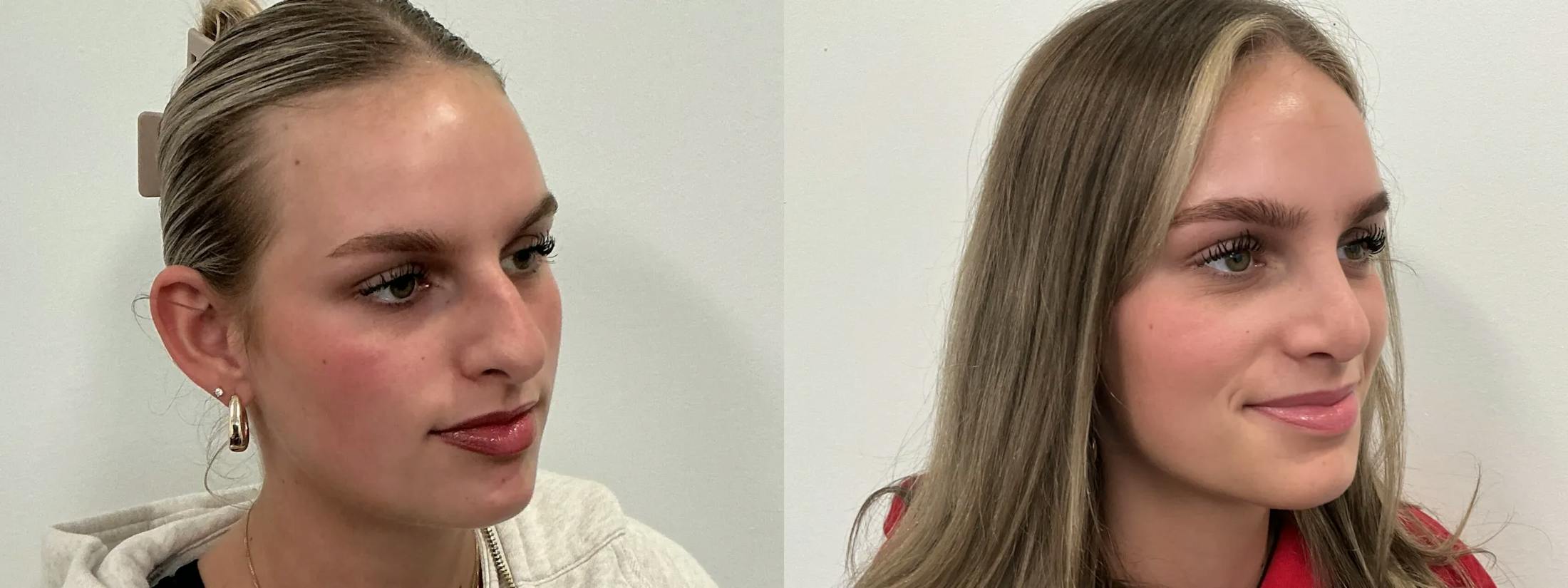 Rhinoplasty Before & After Gallery - Patient 390714 - Image 1