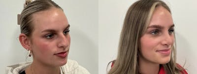 Rhinoplasty Before & After Gallery - Patient 390714 - Image 1