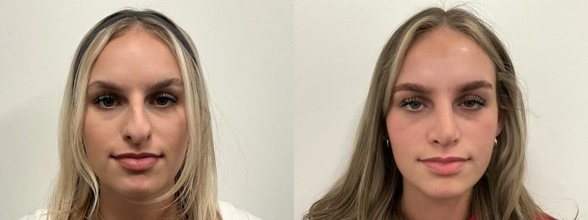 Rhinoplasty Before & After Gallery - Patient 390714 - Image 2