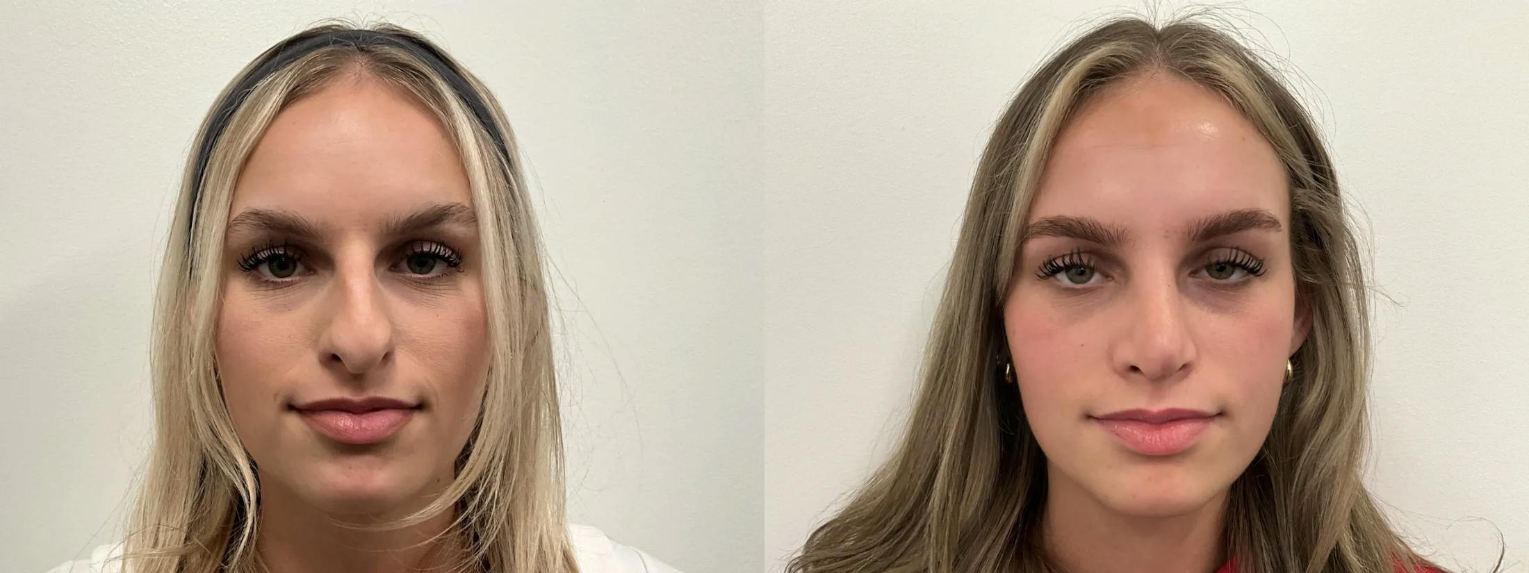 Rhinoplasty Before & After Gallery - Patient 390714 - Image 2