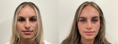 Rhinoplasty Before & After Gallery - Patient 390714 - Image 2