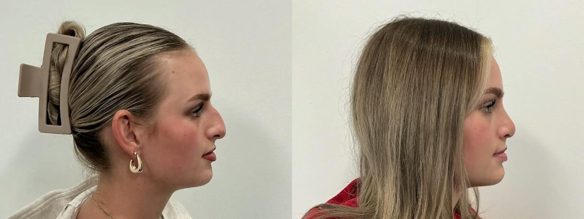 Rhinoplasty Before & After Gallery - Patient 390714 - Image 3