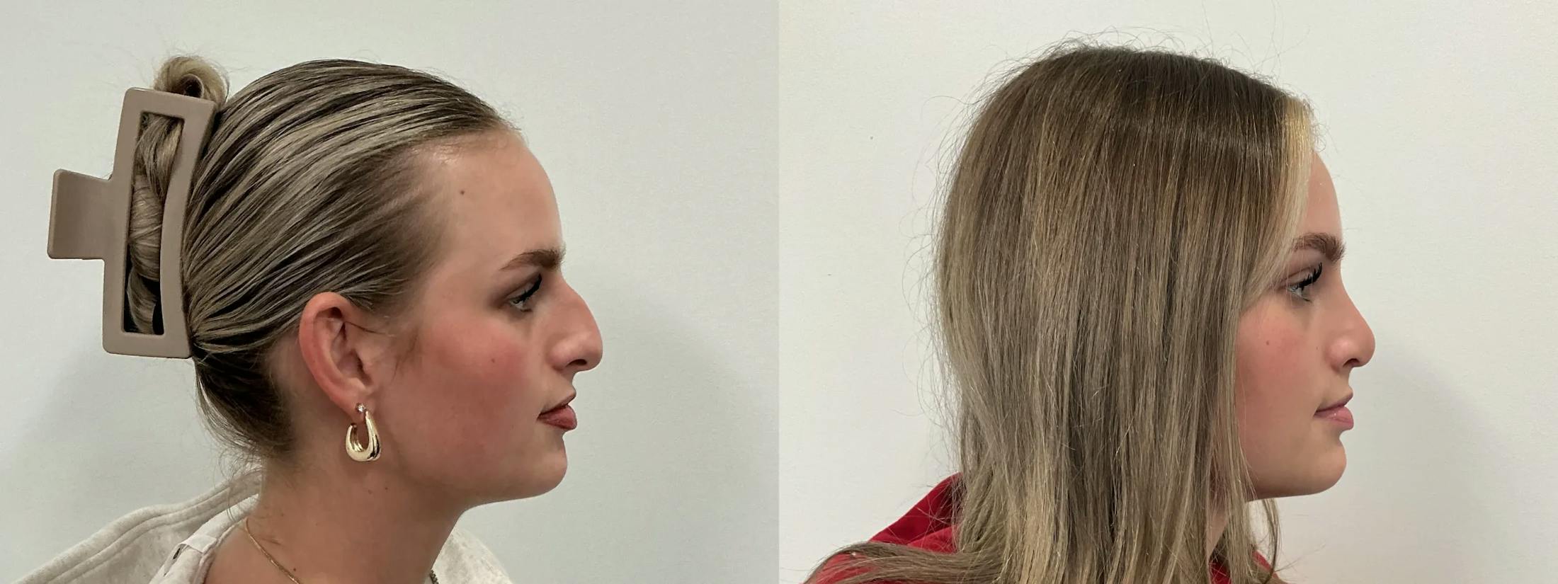 Rhinoplasty Before & After Gallery - Patient 390714 - Image 3