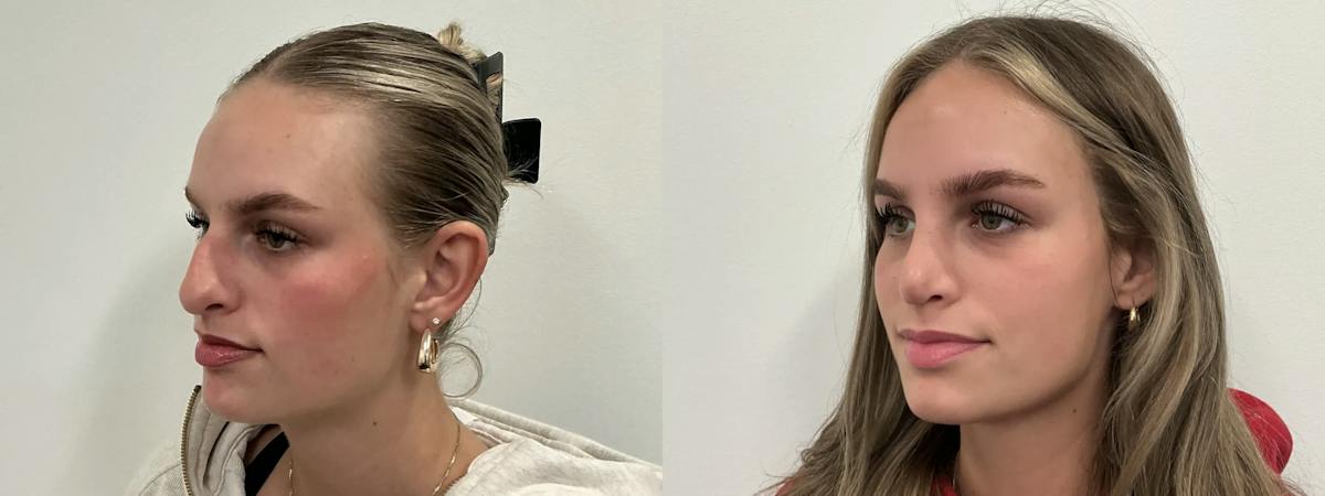 Rhinoplasty Before & After Gallery - Patient 390714 - Image 4