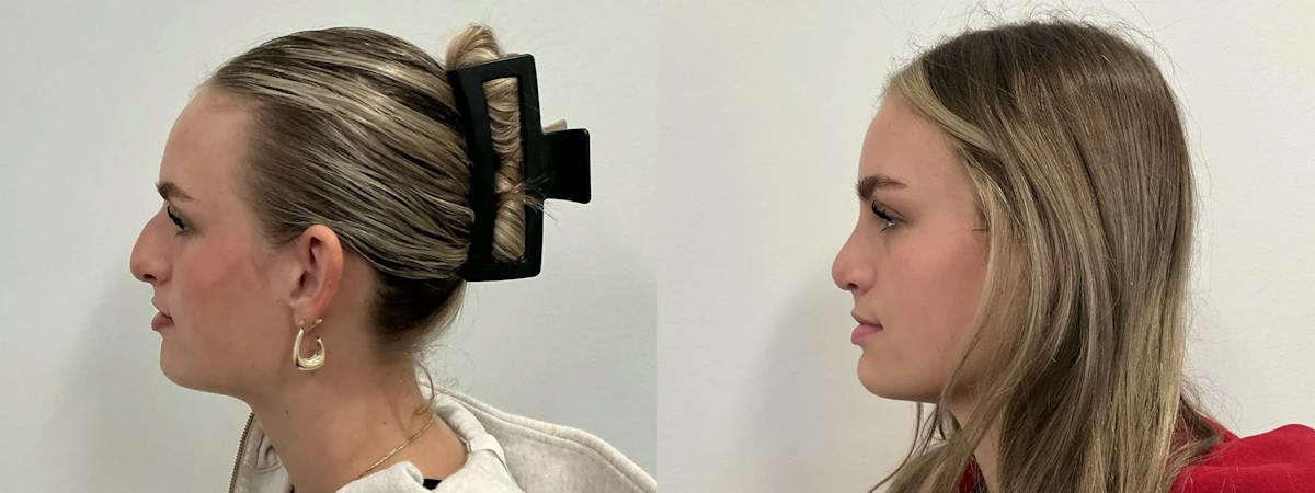 Rhinoplasty Before & After Gallery - Patient 390714 - Image 5