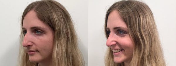 Rhinoplasty Before & After Gallery - Patient 411305 - Image 1