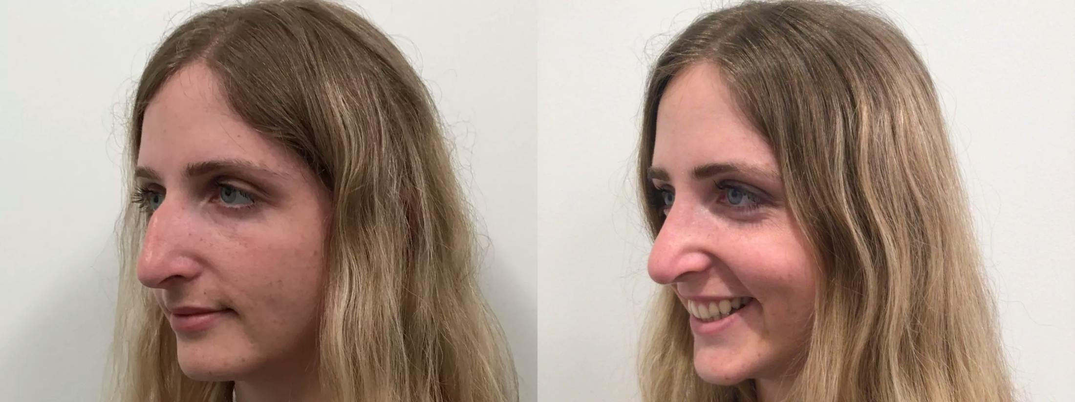 Rhinoplasty Before & After Gallery - Patient 411305 - Image 1