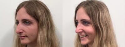 Rhinoplasty Before & After Gallery - Patient 411305 - Image 1
